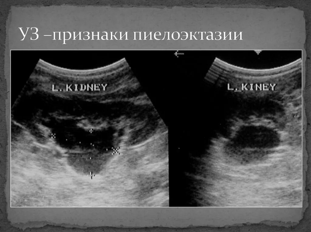 Гидронефроз на узи степени. Пиелоэктазия заключение узи. Двусторонняя пиелоэктазия у плода. Пиелоэктазия почек плода на узи. Гидронефроз почек у плода.