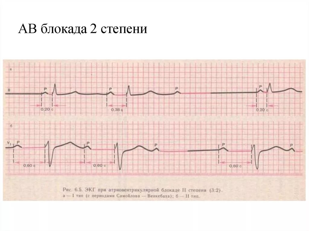 Атриовентрикулярная блокада 2. АВ блокада 2 степени Мобитц 2 на ЭКГ. Av блокада Мобитц 2 ЭКГ. Атриовентрикулярная блокада Мобиц 1 ЭКГ. АВ блокада 2 степени Мобитц 1 на ЭКГ.