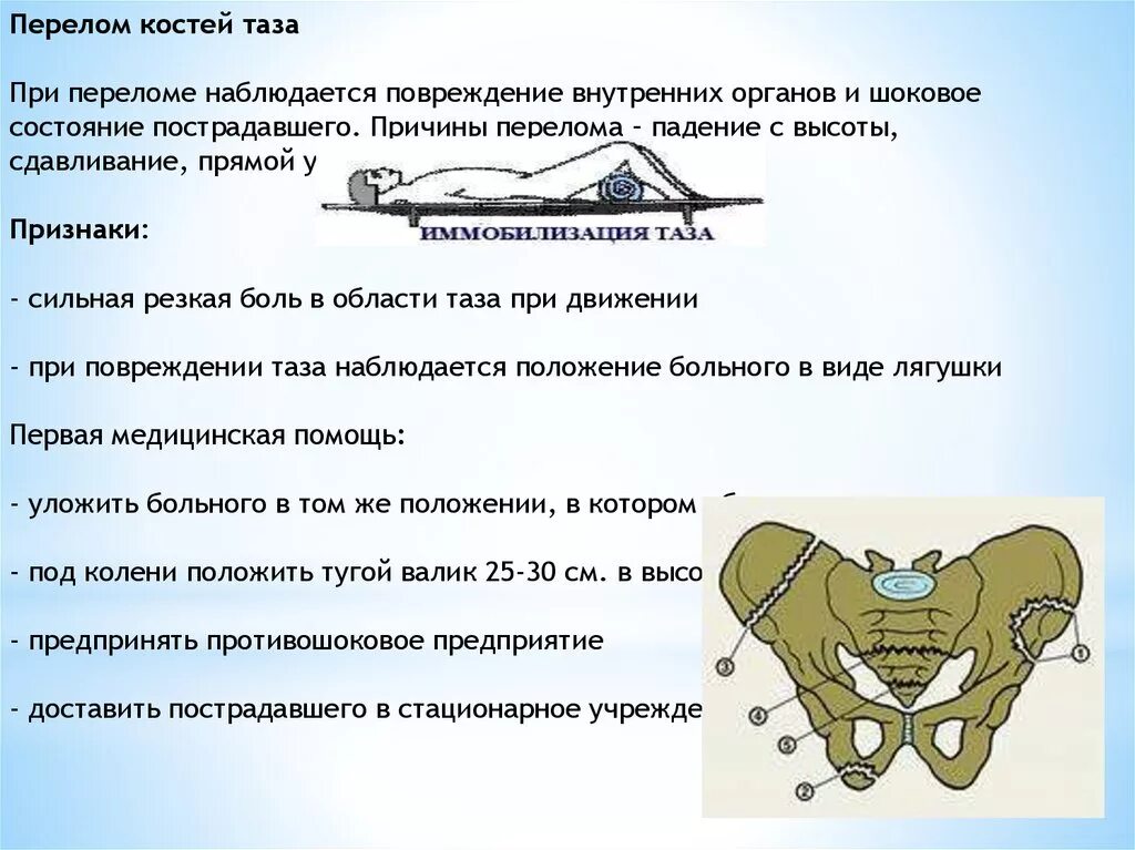 При переломе костей таза. ПМП при переломе костей таза.