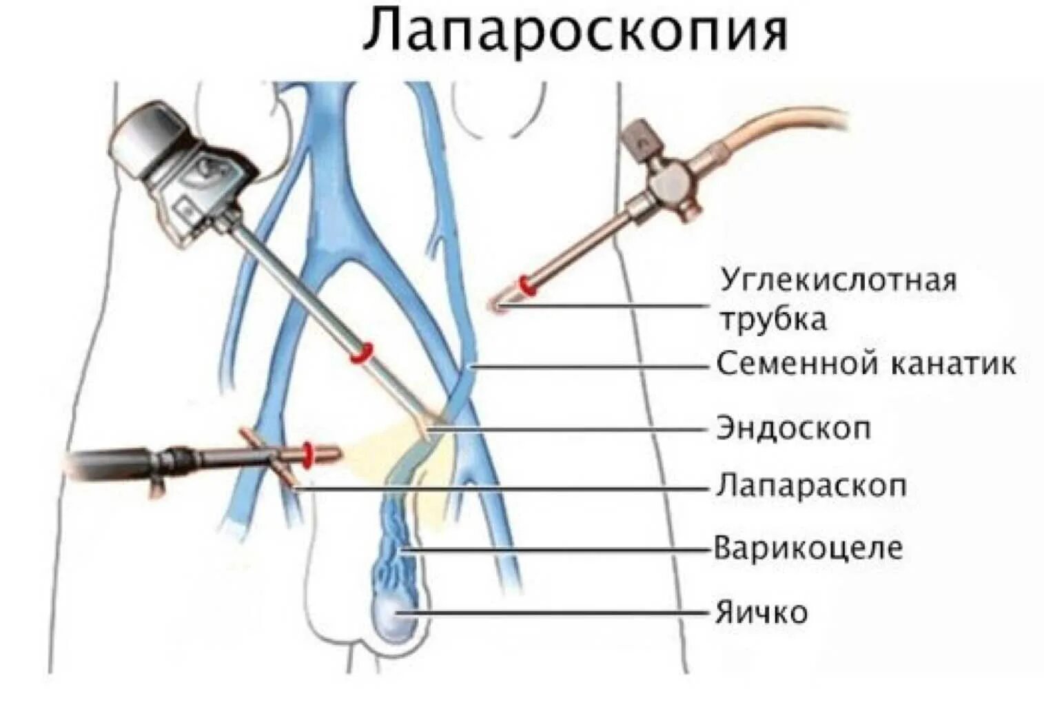 Лапароскопия через сколько можно беременеть