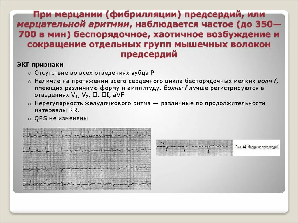 Мерцательная аритмия и фибрилляция предсердий. Фибрилляция предсердий Мерцательная аритмия ЭКГ. Синусовый ритм и фибрилляция предсердий. Волны f при фибрилляции предсердий.