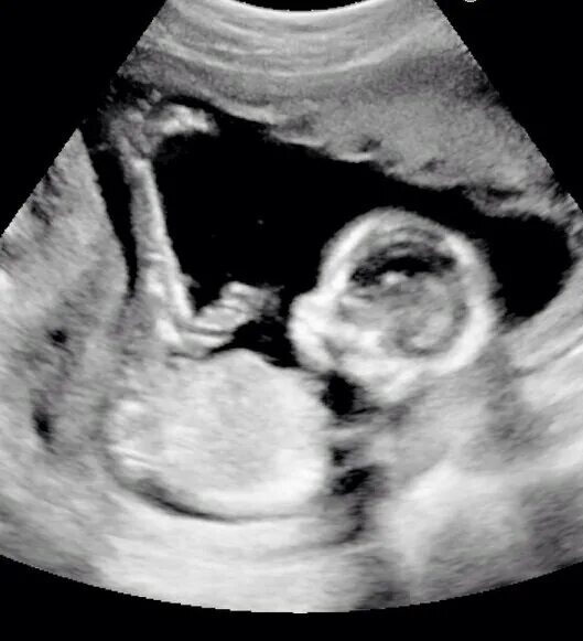 Мозг 20 недель. Снимок УЗИ ребенка 20 недель беременности. Малыш на 20 неделе беременности УЗИ.