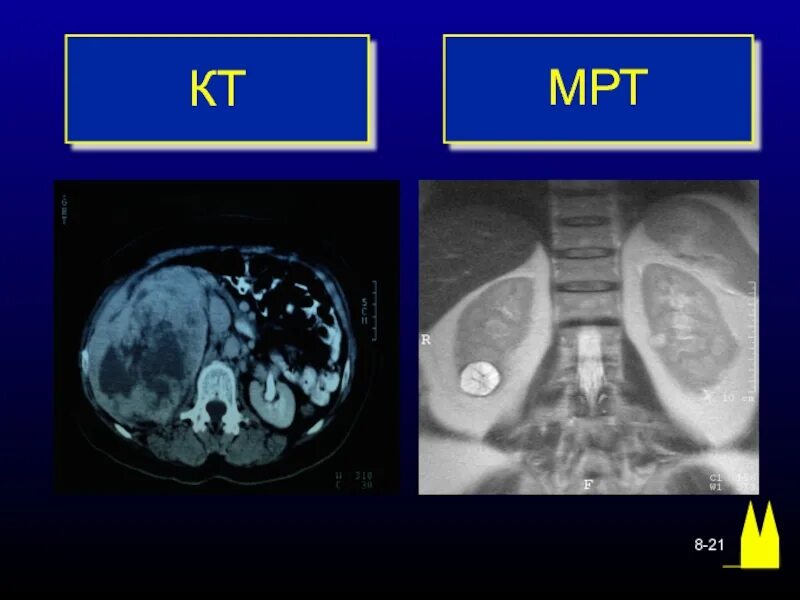 Объемное образование почки MRT. Кт и мрт почек. Разница кт и кт с контрастом