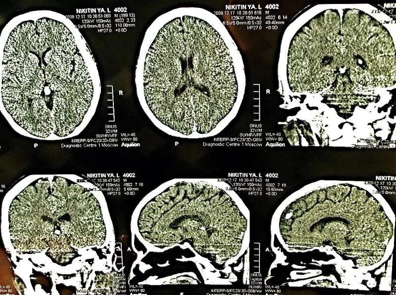 Мрт мозга ульяновске цены. Спайка водопровода мозга мрт. Набор MRT Brain a.