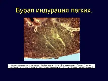 Бурая индурация легких