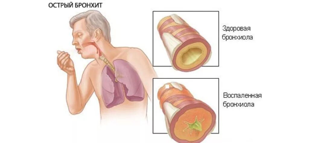 Мокрота после орви. Острый бронхит инфекционного происхождения. Клиническая картина острого бронхита. Воспаление бронхов симптомы. Заболевания органов дыхания бронхит.