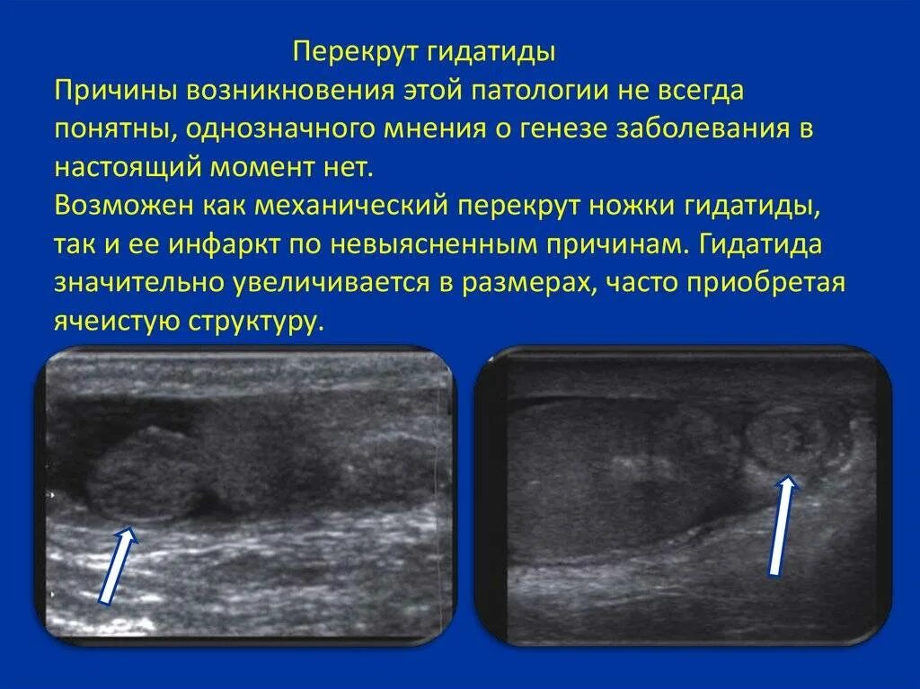 Боль яичка у мужчин причины и лечение. Перекрут гидатиды яичка на УЗИ. Перекрут гитадиды яичника. Перекрут гидатид яичника УЗИ.