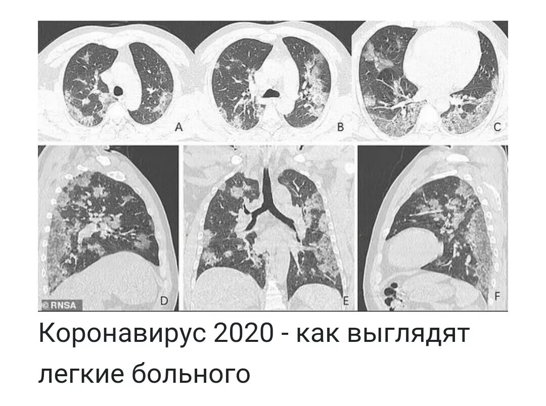 Снимки кт легких. Компьютерная томография легких. Поражение легких на кт. Ковидная пневмония на кт. Кт легких ковид