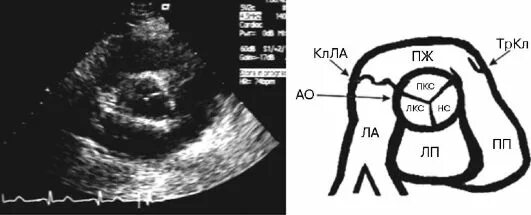 Створки алртального клапана на чпэхо кг. Стеноз аортального клапана эхокг. Эхокг короткая ось на уровне аортального клапана. Створки аортального клапана на эхокг. Кальцинат створок аортального клапана.