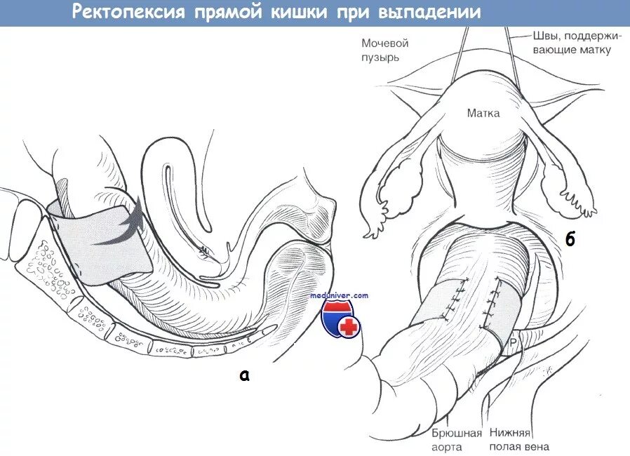 Выпадение кишки операция