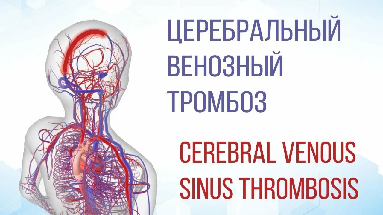 Тромбоз церебральных синусов. Тромбоэмболия сосудов головного мозга. Тромбоз церебральных венозных синусов. Тромбоз сосудов головного мозга. Церебрального тромбоза