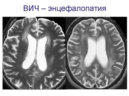 Вич мозга