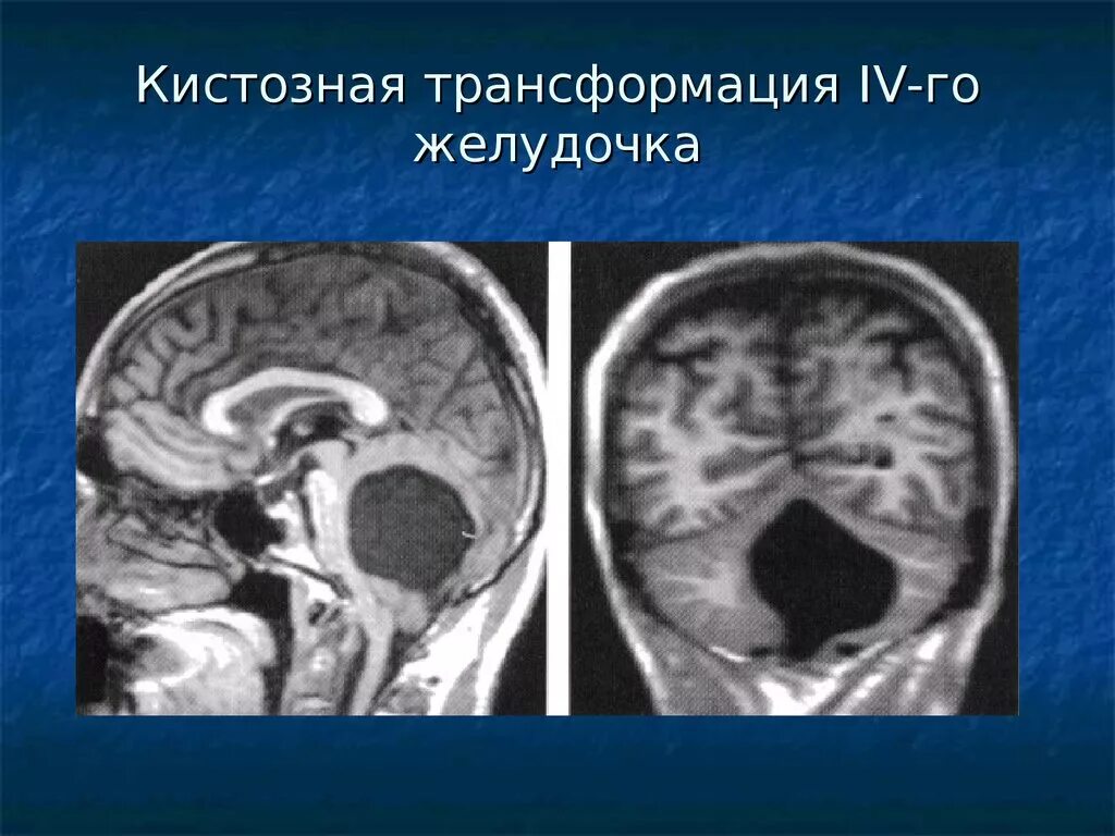 Арахноидальная киста 4 желудочка. Аномалии развития желудочков головного мозга. Аномалии желудочков головного мозга кт. Аномалии развития желудочков головного мозга кт.