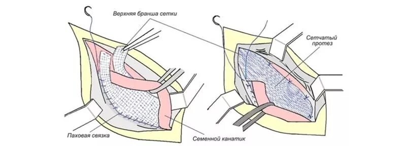 Больничный после операции на паховой грыже. Операция Лихтенштейна при паховой грыже схема. Герниопластика по Лихтенштейну. Операции герниопластика схемы. Герниопластика по Лихтенштейну при паховой грыже.