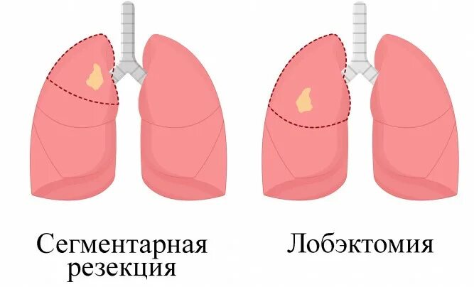 Расширенная верхняя лобэктомия. Лобэктомия что это