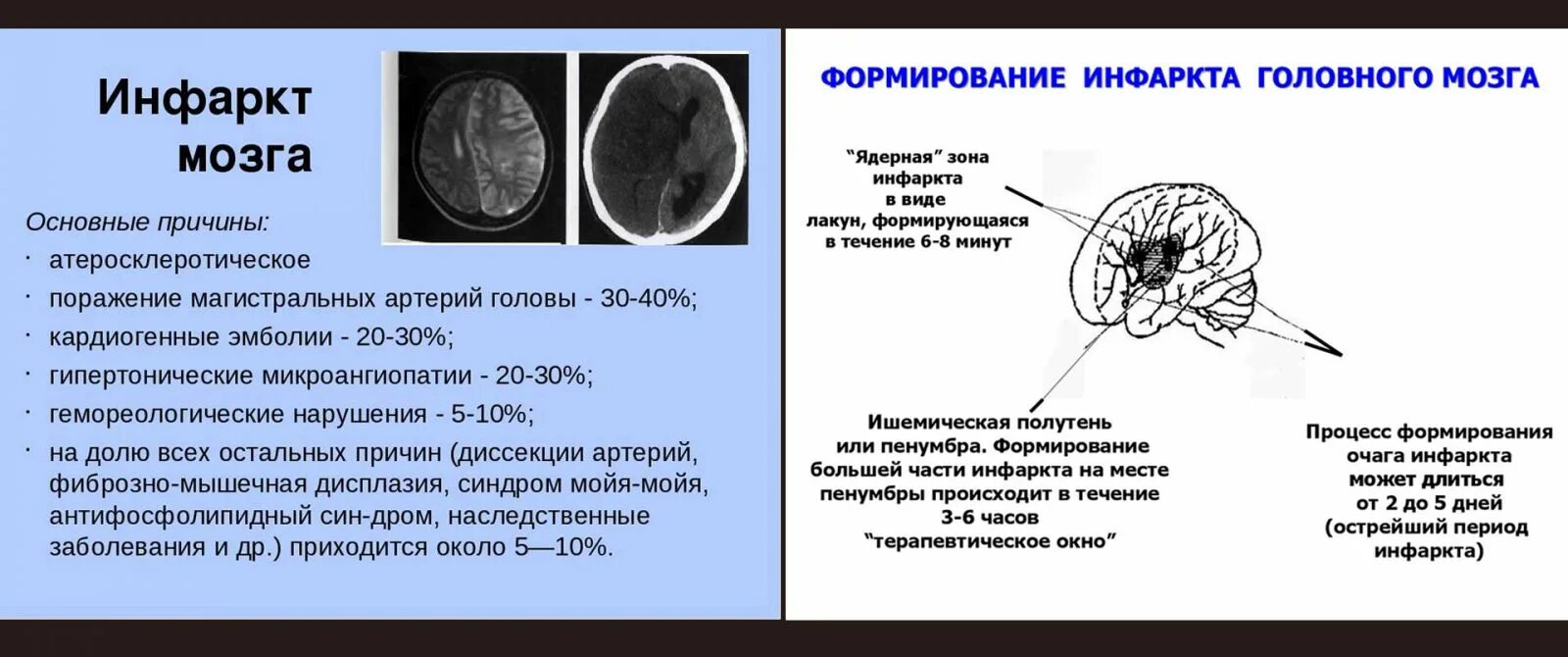 Чем отличается инфаркт от инсульта простыми. Причины развития инфаркта головного мозга. Ишемический инсульт (инфаркт мозга). Причины развития ишемического инфаркта головного мозга. Исходы ишемического инфаркта мозга.