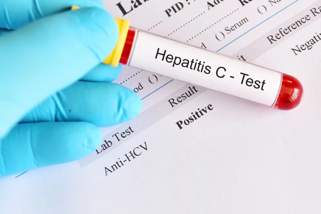 Тест на донора крови. Вирус Hepatitis c. Hepatit c исследование антител. Тест на гепатит с.