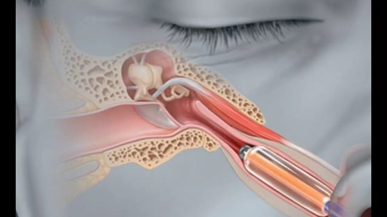 Катетеризация евстахиевой трубы. Дренирование евстахиевой трубы. Евстахиева труба катетеризация. Евстахиит барабанная перепонка. Расширив проход