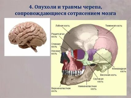 Опухоль головного черепа