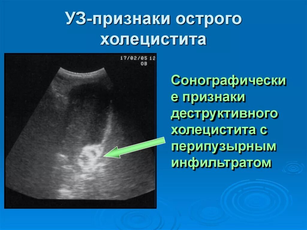 ЖКБ острый калькулезный холецистит. Калькулезный холецистит на УЗИ. Острый калькулезный холецистит на УЗИ. Хронический калькулезный холецистит на кт. Холецистит камень в желчном пузыре