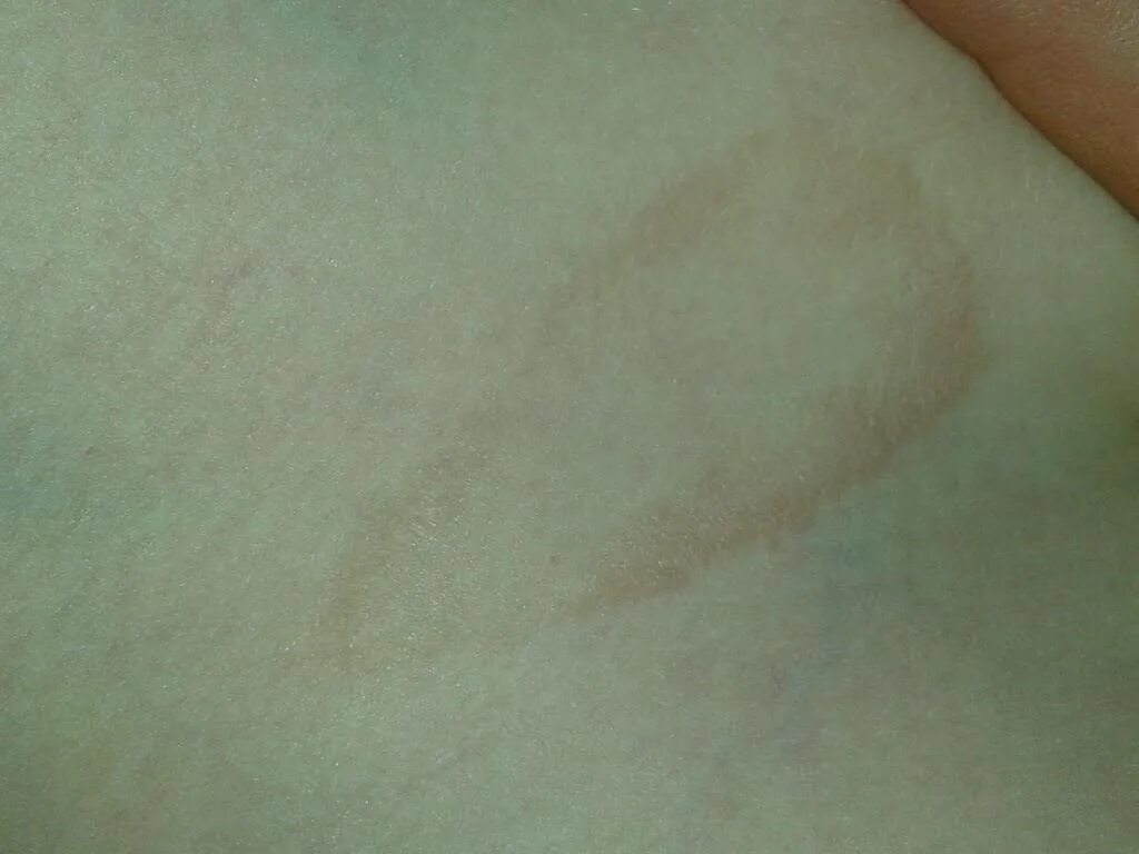 Кольцевидная эритема укус. Разноцветный лишай (Pityriasis versicolor). Склероатрофический Лихен. Отрубевидный лишай Видаля. Слизистые покровы или гладкая поверхность мелкие