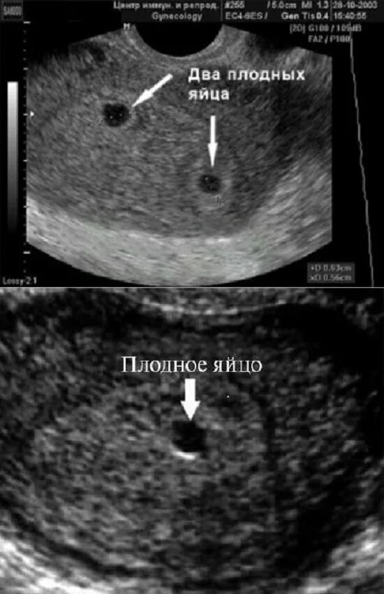 Плод в полости матки. Эмбрион на 5 неделе беременности УЗИ. УЗИ плодного яйца на 5 неделе беременности. Эмбрион на УЗИ 4-5 недель беременности. УЗИ плодное яйцо в полости матки при беременности 5 недель.