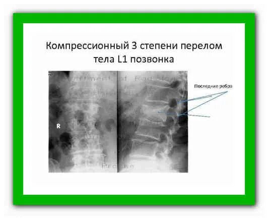 Степени компрессионных переломов тел позвонков. Компрессионный перелом 1 позвонка 2 степени. компрессионный перелом 3 позвонка 1 степени. компрессионный перелом тела l3 позвонка 3 степени.. компрессионный перелом тела l1 позвонка 2 степени.