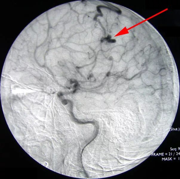 Артериовенозная мальформация (АВМ). Артериовенозная мальформация вены Галена. АВМ сосудов головного мозга. Артериовенозные мальформации (АВМ) головного мозга.. Ангиома правой лобной доли