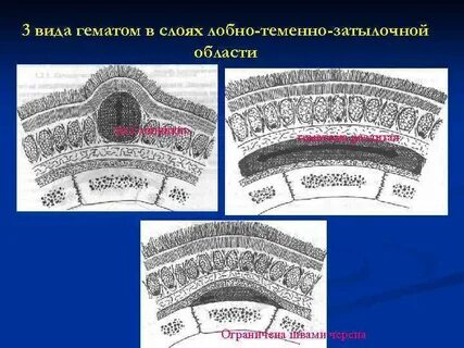 Виды гематом