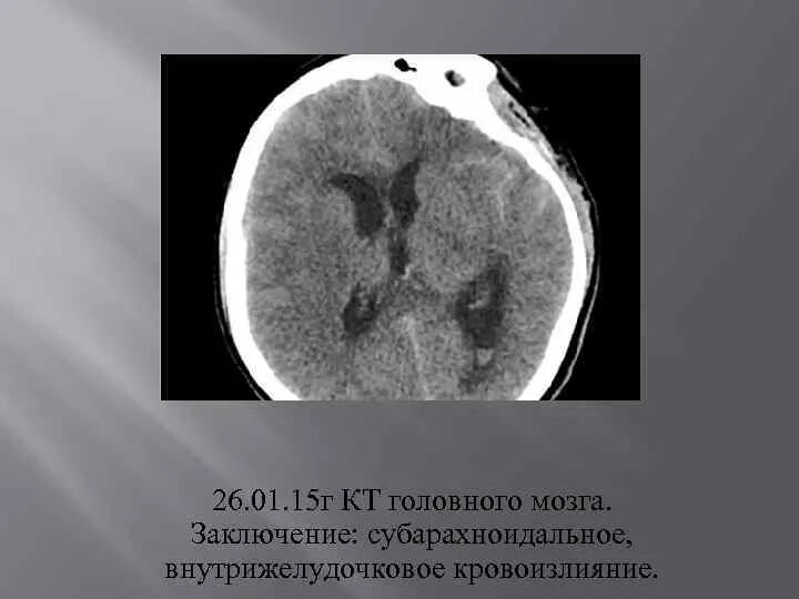 Внутрижелудочковое кровоизлияние. Субарахноидальное внутрижелудочковое кровоизлияние. внутрижелудочковое кровоизлияние кт. внутрижелудочковая гематома на кт. внутрижелудочковые кровоизлияния мрт.