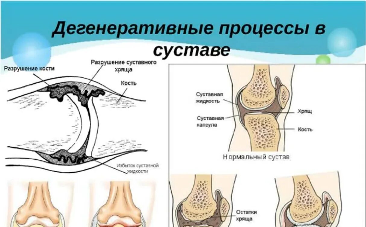 Болезнь которая разрушает кости. Разрушение кости и сустава. Разрушение костей в суставе.