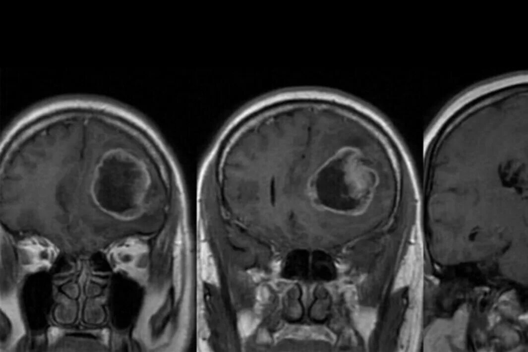 У него рак мозга. Опухоль головного мозга на кт. Опухоль головного мозга 3 стадия. У него рак мозга. Глиобластома головного мозга.