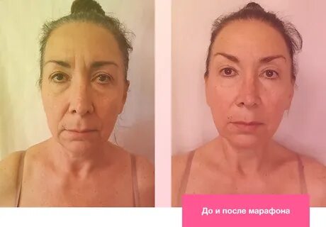 Уколы гиалуроновой кислоты вред
