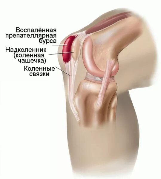 Воспаление коленных связок лечение. Препателлярный бурсит коленного сустава симптомы. Бурсит сухожилия гусиной лапки коленного сустава. Острый бурсит коленного сустава. Тендинит бурсит коленного сустава.