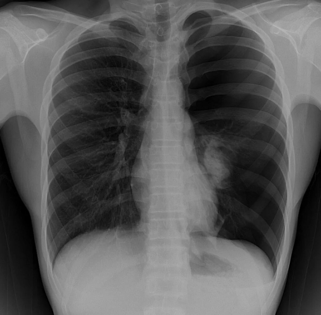 Двусторонний пневмоторакс рентген. Пневмоторакс легких рентген. Рентгенография грудной клетки пневмоторакс. Парциальный пневмоторакс.