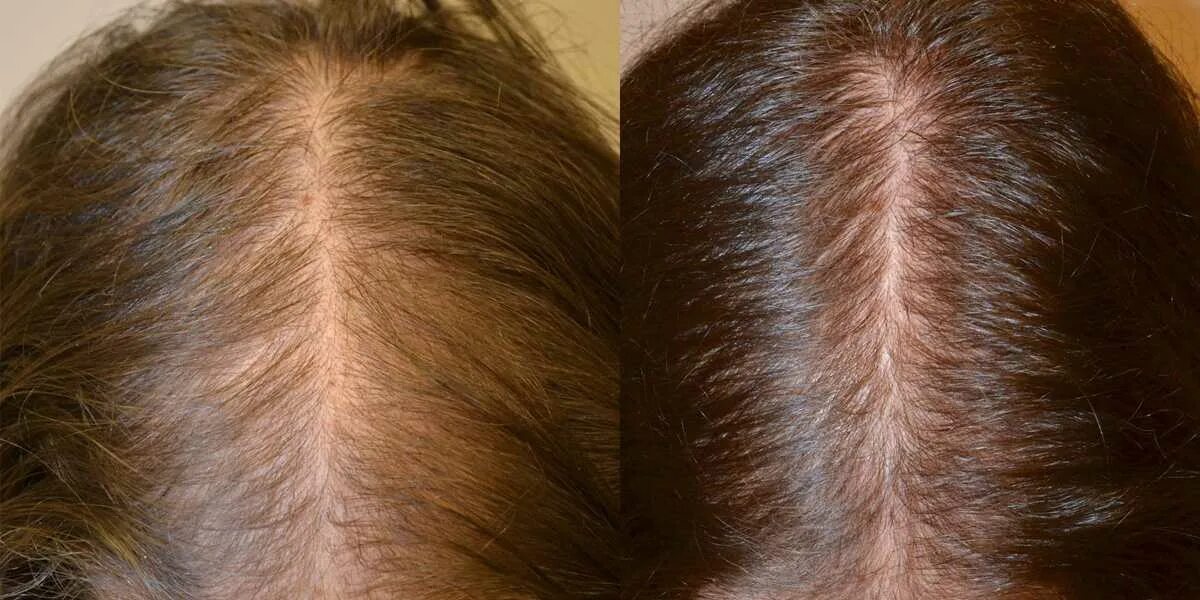 Волосы выпадают после лечения. Андрогензависимая алопеция. Андрогенетическая алопеция волосы. Андрогенная алопеция алопеция. Андрогенная алопеция трихограмма.