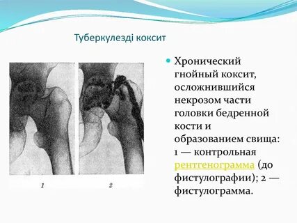 Коксит