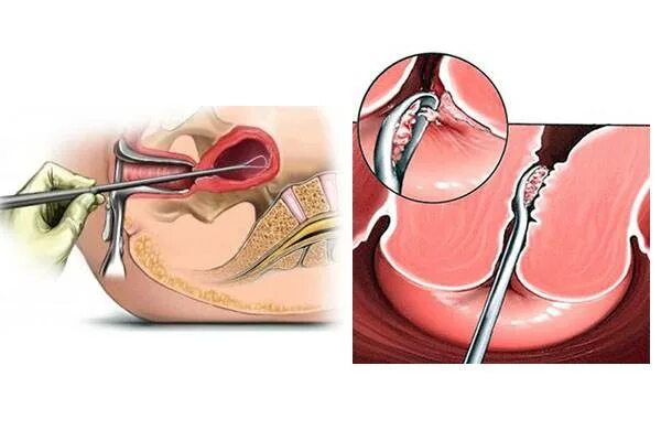 Выскабливание цервикального канала шейки. Выскабливание слизистой оболочки цервикального канала. Раздельное диагностическое выскабливание цервикального канала. Выскабливание слизистой оболочки канала шейки матки. После выскабливание цервикального канала