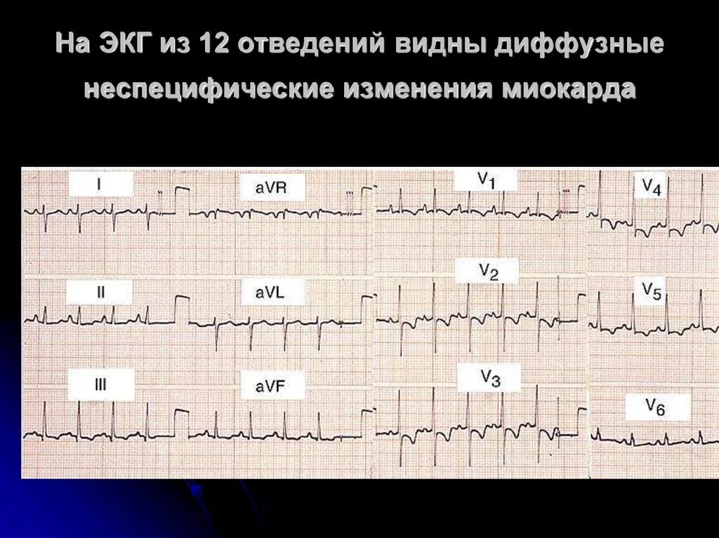 Диффузные изменения лж. Диффузное поражение миокарда ЭКГ. ЭКГ при метаболических изменениях миокарда. Диффузные неспецифические изменения миокарда на ЭКГ. Неспецифические изменения в миокарде на ЭКГ что это.