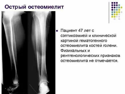 Острый остеомиелит признаки