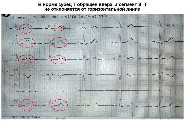 Ось qrs норма экг. Кардиограмма отклонение параметров. Кардиограмма отклонение параметров. Экг отклонение параметров qrs 111. Экг норма расшифровка.