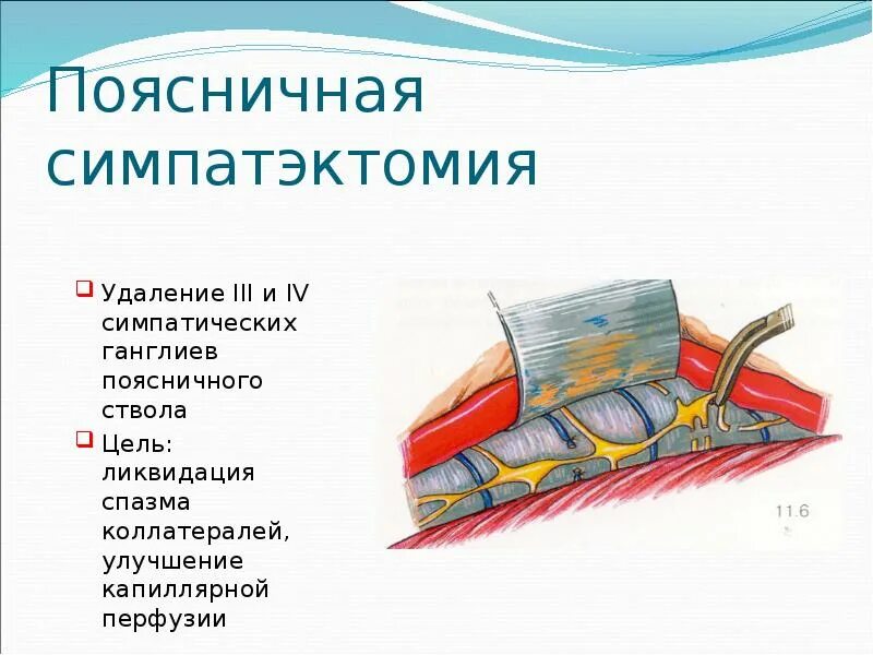 Симпатэктомия цена. Поясничная симпатэктомия ход операции. Периартериальная симпатэктомия. Операция симпатэктомия. Люмбальная симпатэктомия.