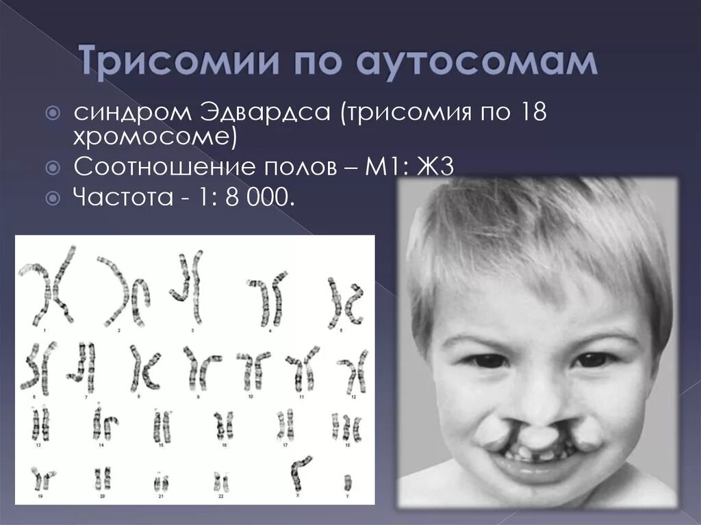 Синдром Дауна Эдвардса. Синдром Эдвардса кариотип. Болезнь с лишней хромосомой