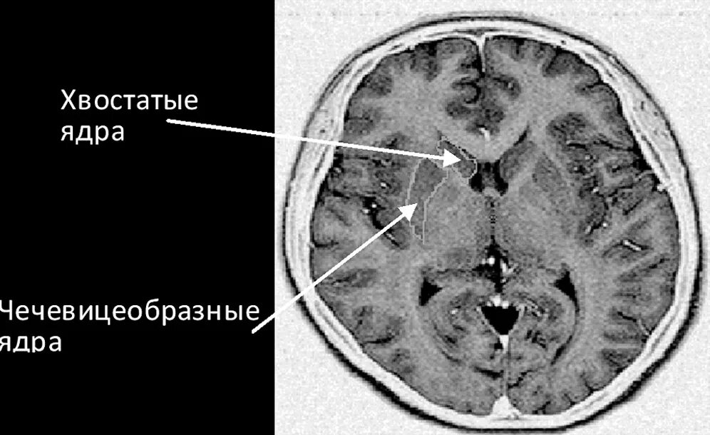 Хвостатое ядро мозга. Чечевицеобразное ядро мрт. Ядра головного мозга кт. Хвостатое ядро и чечевицеобразное ядро. Хвостатое ядро мозга кт.