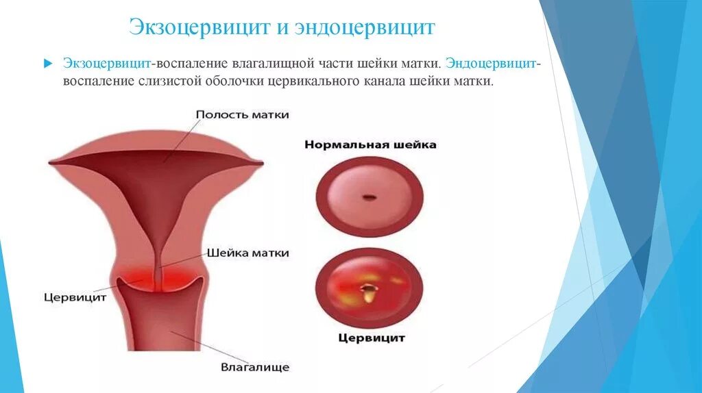 Какая матка при воспалении. Воспалительный процесс слизистой оболочки экзоцервицит. Воспалительный процесс слизистой оболочки шеечного канала. Воспалительная болезнь шейки матки n72.