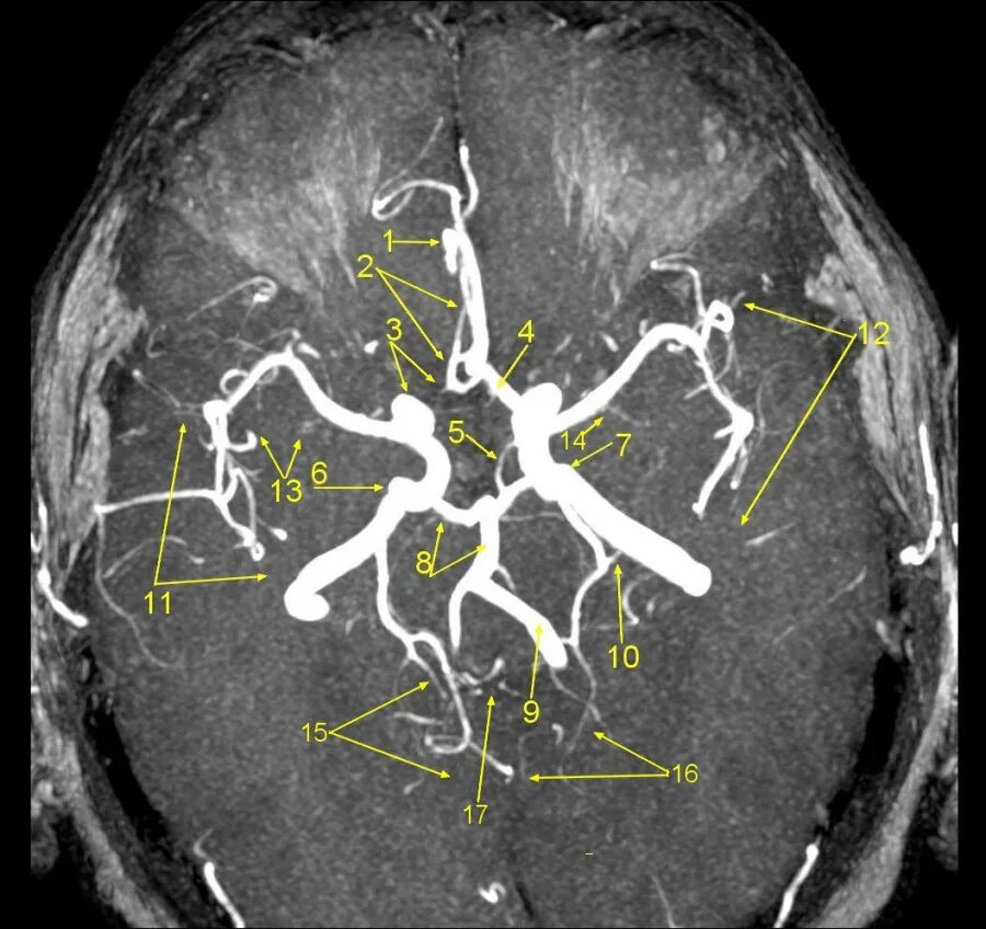 Интракраниальные артерии головного мозга. А1 сегмент передней мозговой. Сегменты передней мозговой артерии а1 а2. А 1 сегмент передней мозговой артерии на мрт. М1 сегмент средней мозговой артерии мрт.