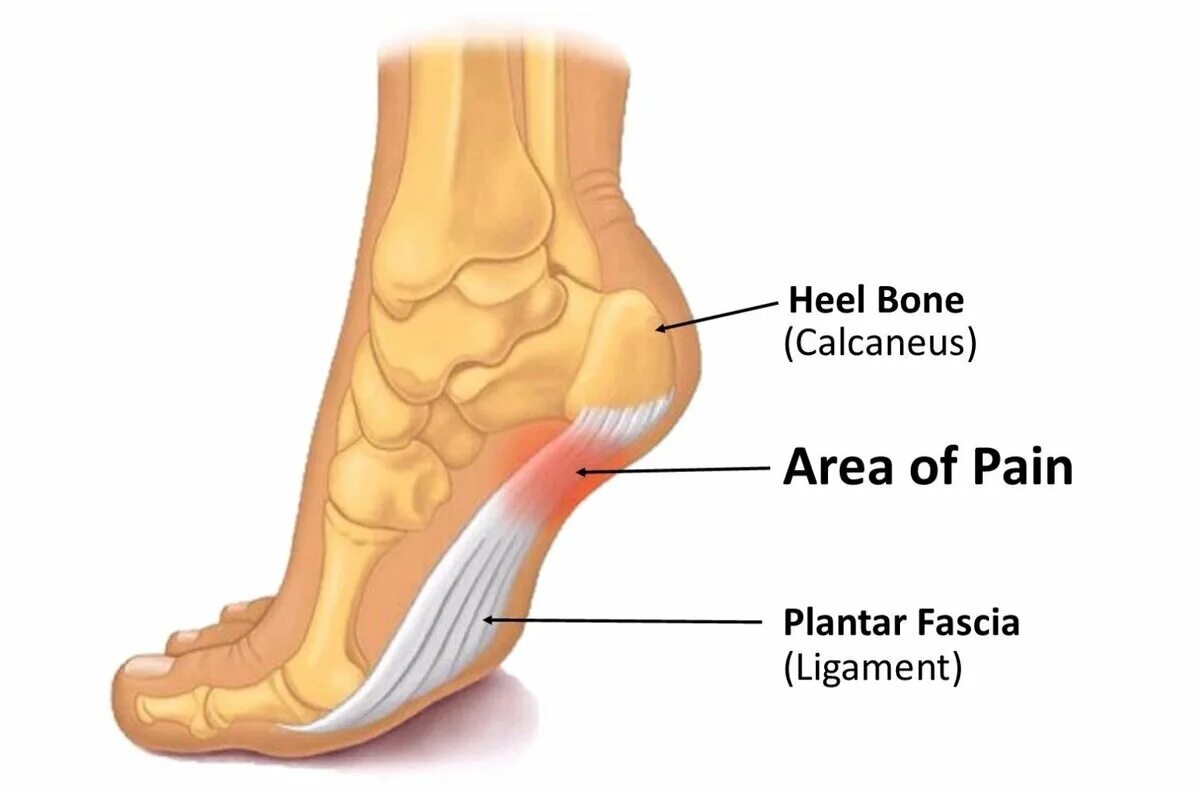 Болит изгиб ноги. Плантарный апоневроз стопы. Плантарный фасциит мкб 10. Пяточная шпора плантарный фасциит. Фасциит голеностопного сустава.