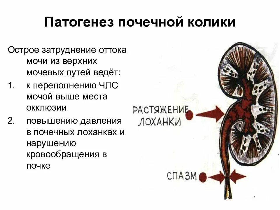 При почечной колике возможна. Патогенез почечной колики. Этиология и патогенез почечной колики. Мочекаменная болезнь почек патогенез. Почечная колика причины патогенез.