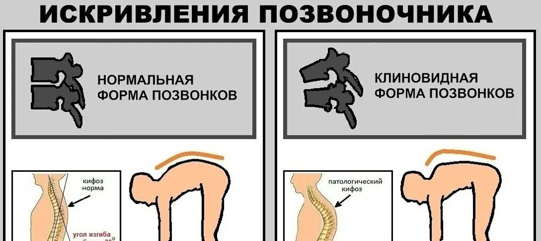 Правильный прогиб позвоночника. Нормальный прогиб в пояснице. Нормальная кривизна позвоночника. Нормальный изгиб спины.