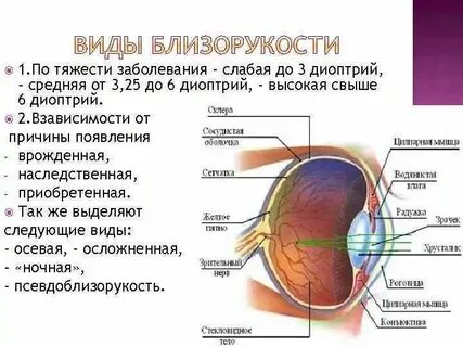 Миопия слабой степени код по мкб